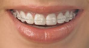 apparecchi-ortodontici