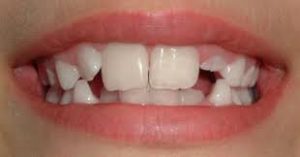 ricostruzione-dente