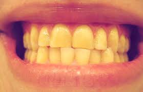 denti-gialli