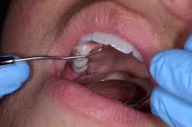 impianto osseo dentale