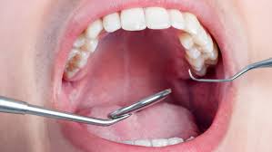 demineralizzazione denti
